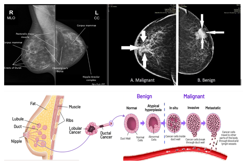 Ml detection breast cancer